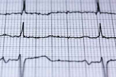 U of G Researchers Discover Potential Drug to Treat Heart Attacks