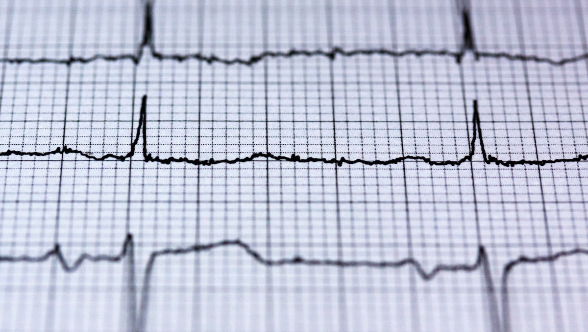 This photo shows a cardiac rhythm on a heart monitor