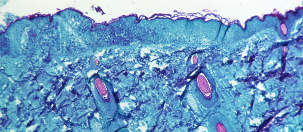 A microscopic image of skin tissue from a monkey infected with monkeypox virus